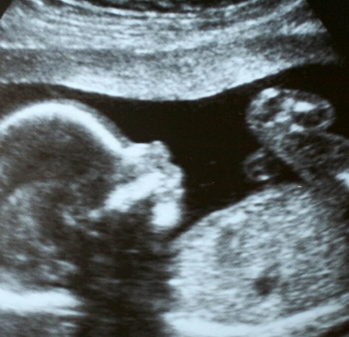 California AG Faces First Amendment Fight Over Abortion Pill Reversal