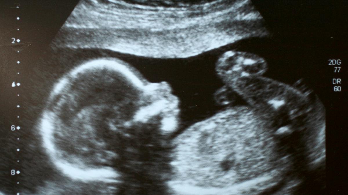 California AG Faces First Amendment Fight Over Abortion Pill Reversal